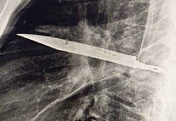 Reprodução/Journal of Surgical Case Reports