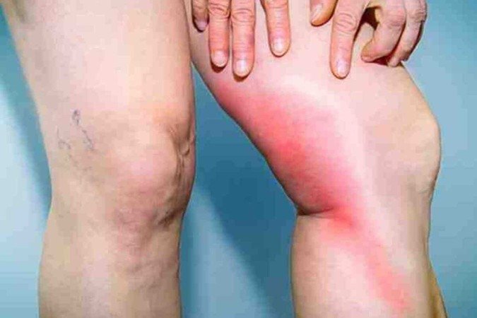 O lipedema, que costuma causar dor e hematomas, é resistente a dietas convencionais - (crédito: Reprodução/Pinterest) O lipedema, que costuma causar dor e hematomas, é resistente a dietas convencionais - (crédito: Reprodução/Pinterest)