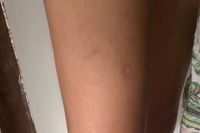 ClÃ¡udia sofreu mordidas nas pernas, joelho e ombro
