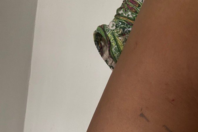 Cláudia sofreu mordidas nas pernas, joelho e ombro