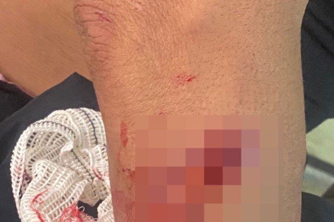 Cláudia sofreu mordidas no braço, nas pernas, no joelho e no ombro - (crédito: Material cedido ao Correio) Cláudia sofreu mordidas no braço, nas pernas, no joelho e no ombro - (crédito: Material cedido ao Correio)