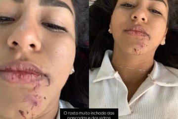 Jovem envolvida em acidente na BR-020 mostra machucados