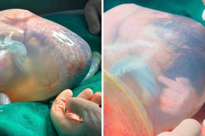 Nos dois casos, os partos eram gemelares, mas só um bebê de cada dupla nasceu empelicado - (crédito: Hospital Marieta Konder Bornhausen) Nos dois casos, os partos eram gemelares, mas só um bebê de cada dupla nasceu empelicado - (crédito: Hospital Marieta Konder Bornhausen)