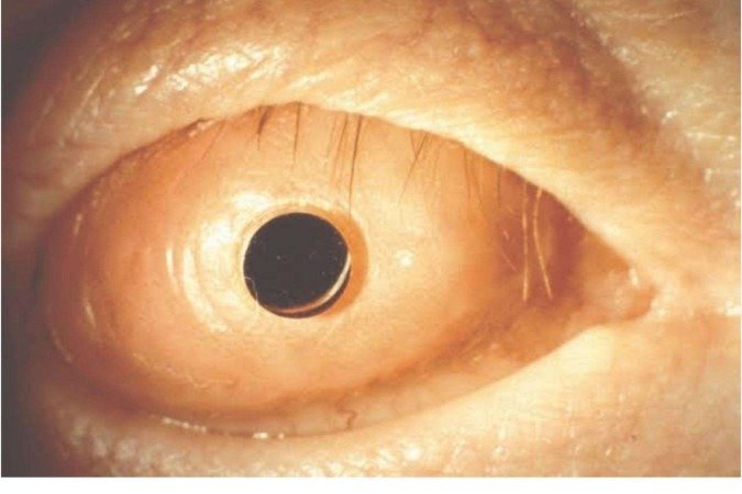  Uma lente é instalada no orifício aberto no canino deslocado: retomada a visão -  (crédito:  Divulgação)