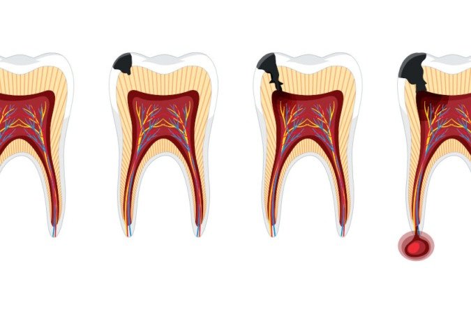 Combinação de exercício físico e ômega-3 reduz infecção na raiz do dente