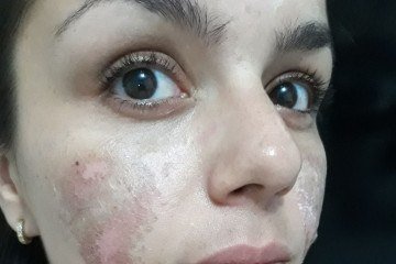 Após realizar um procedimento estético em casa, Lorena teve sua pele queimada 