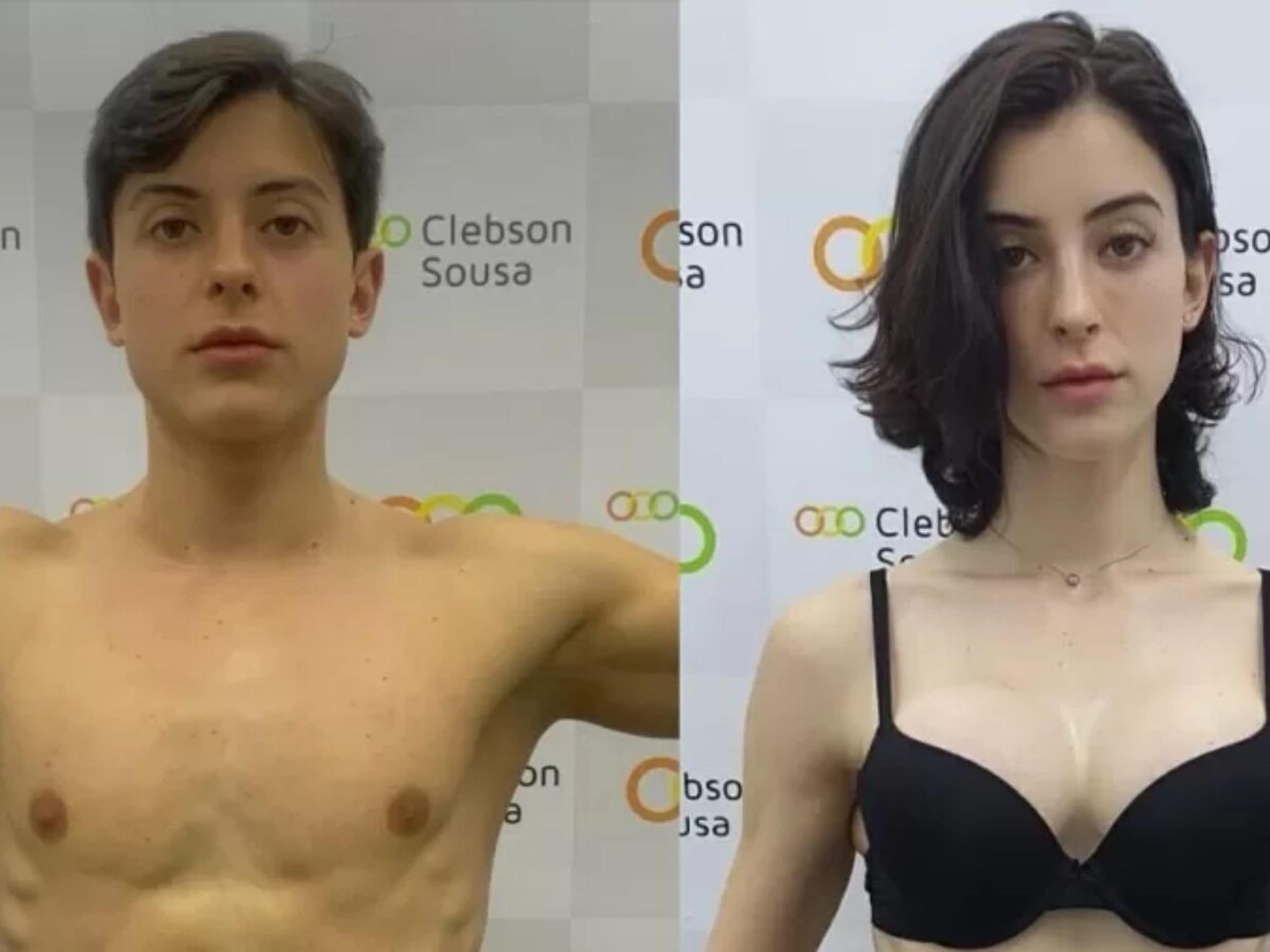A jovem começou a transição em janeiro, passando por tratamento hormonal e procedimentos como feminilização facial e implante de silicone -  (crédito: Reprodução/Instagram)