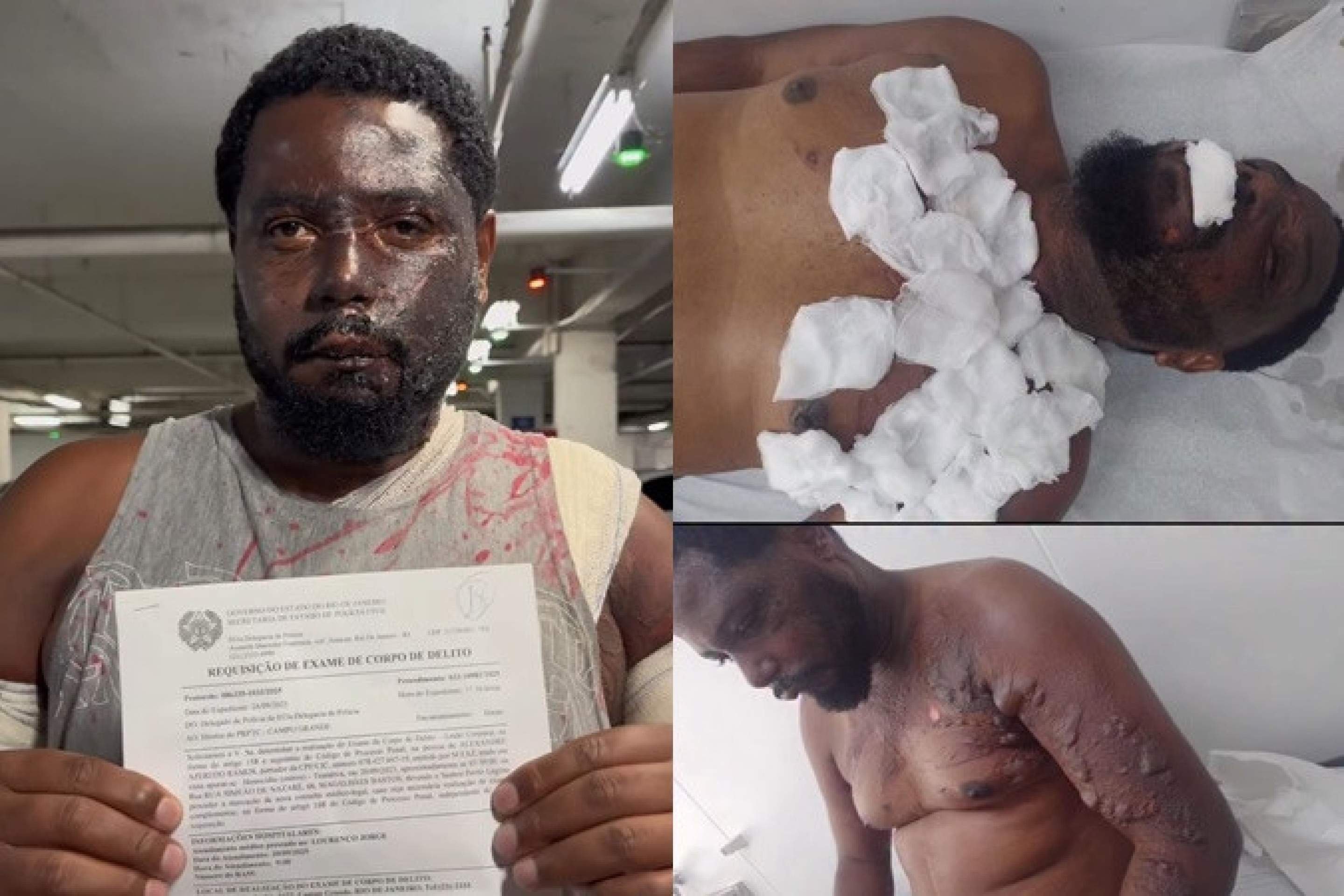 Homem sofre queimaduras após ser atacado com água fervente pela companheira