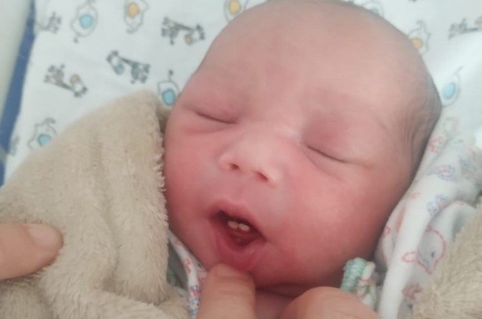 Bebê nasce com dois dentes em hospital do DF e surpreende família