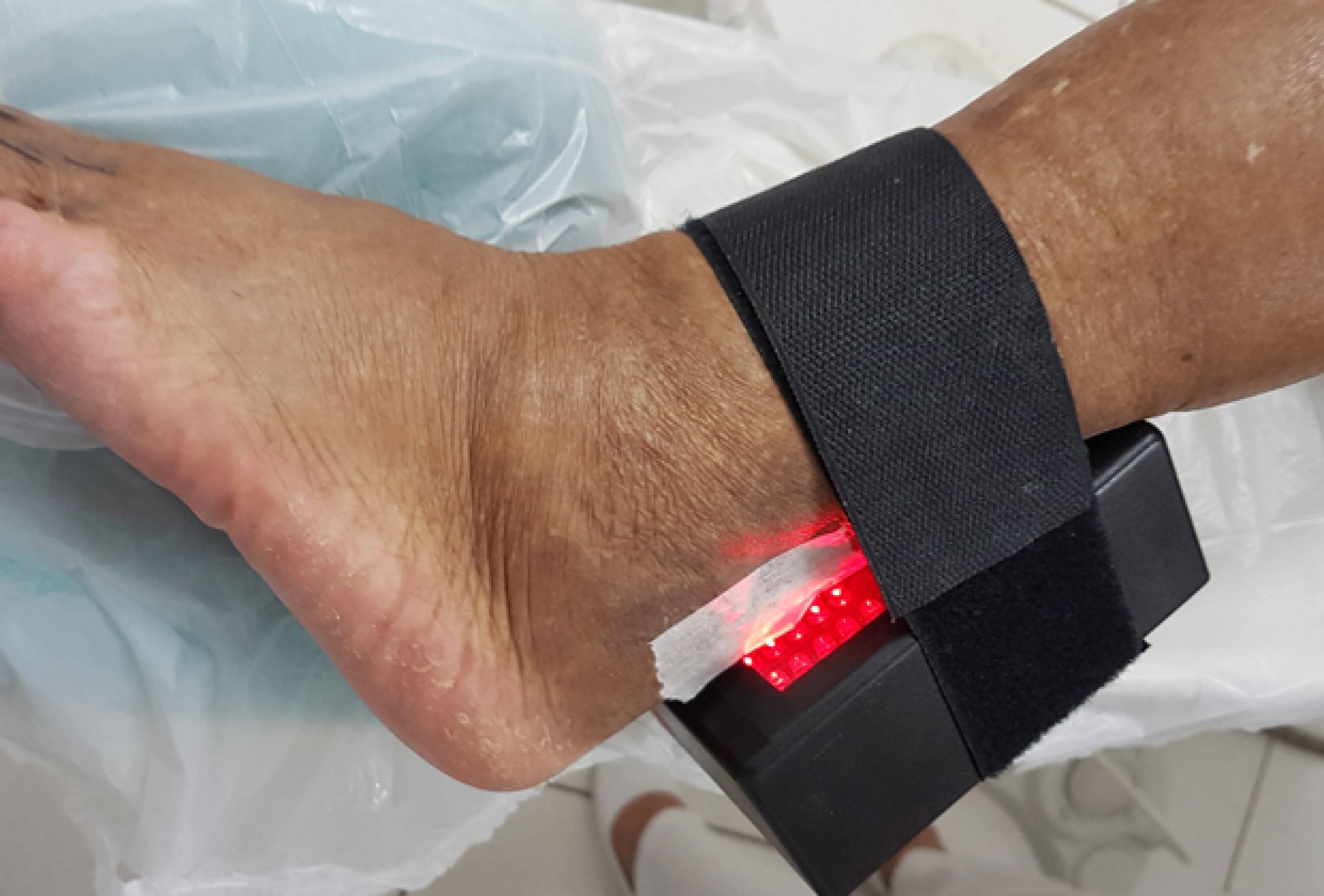 Projeto Rapha: equipamento evita amputações dos 