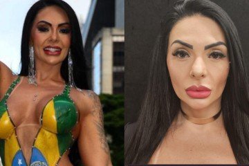 Musa do Brasileirão faz harmonização e preenchimento definitivo para corrigir assimetria na face  -  (crédito: Reprodução/Instagram)