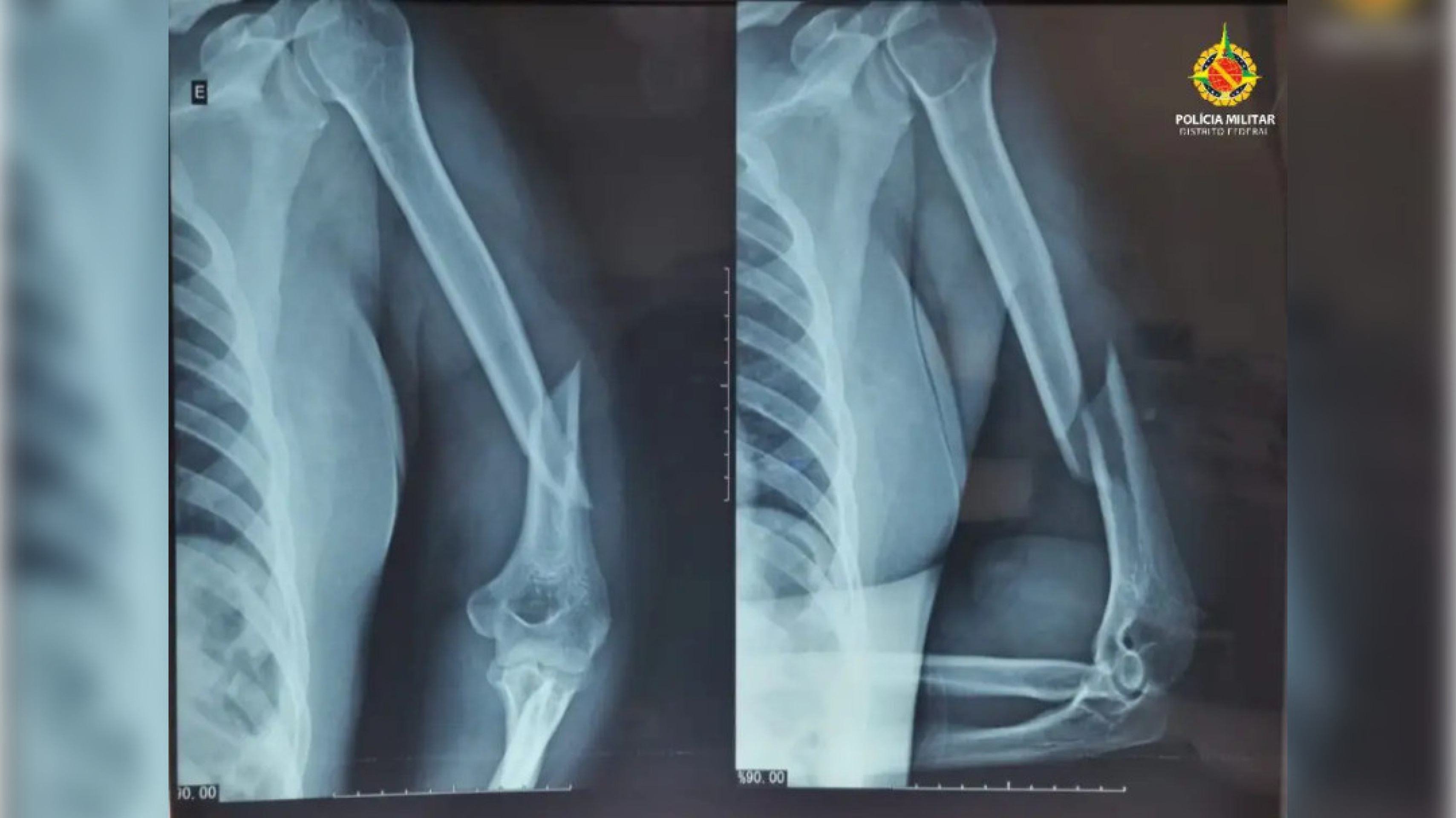 Homem é preso por torturar e tentar matar companheira em Taguatinga