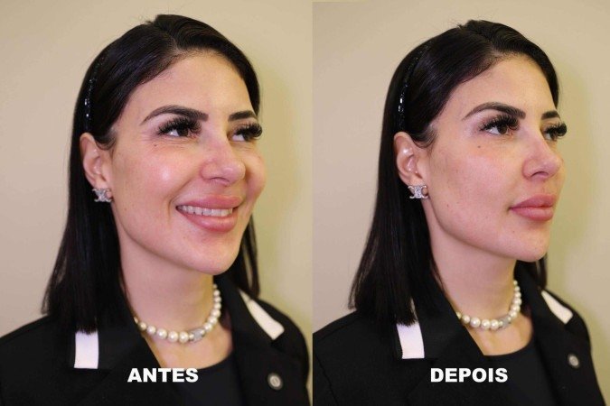 Influenciadora Dillyene Santana passa por harmonização facial -  (crédito: Divulgação)