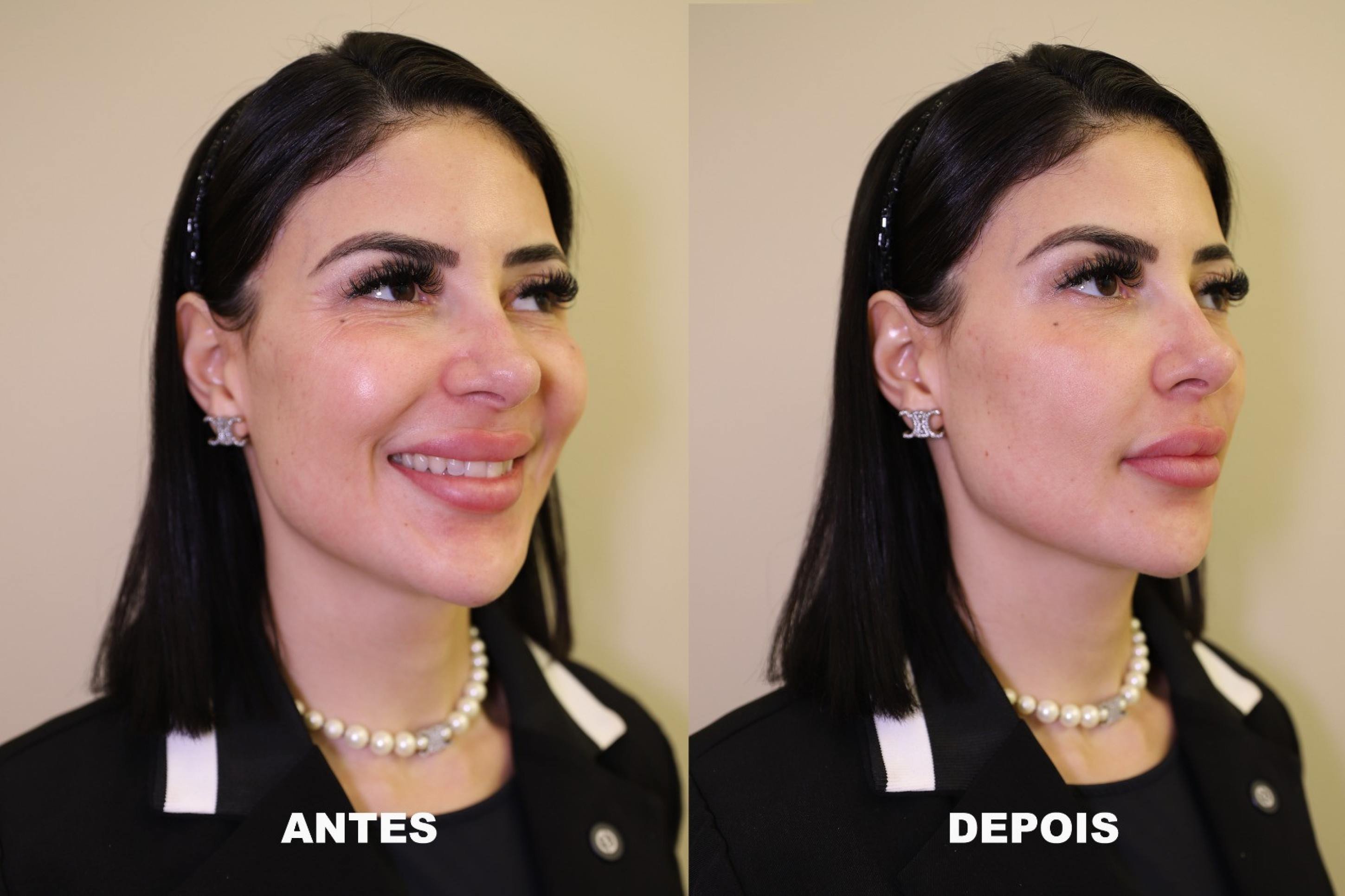 Influenciadora Dillyene Santana passa por harmonização facial
