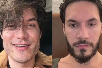 O também ex-bbb, Eliezer decidiu reverter a harmonização facial