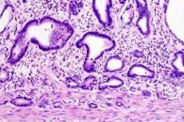  Adenocarcinoma gástrico, o tipo de câncer estomacal mais comum  -  (crédito: WikimediaCommons/Divulgação )