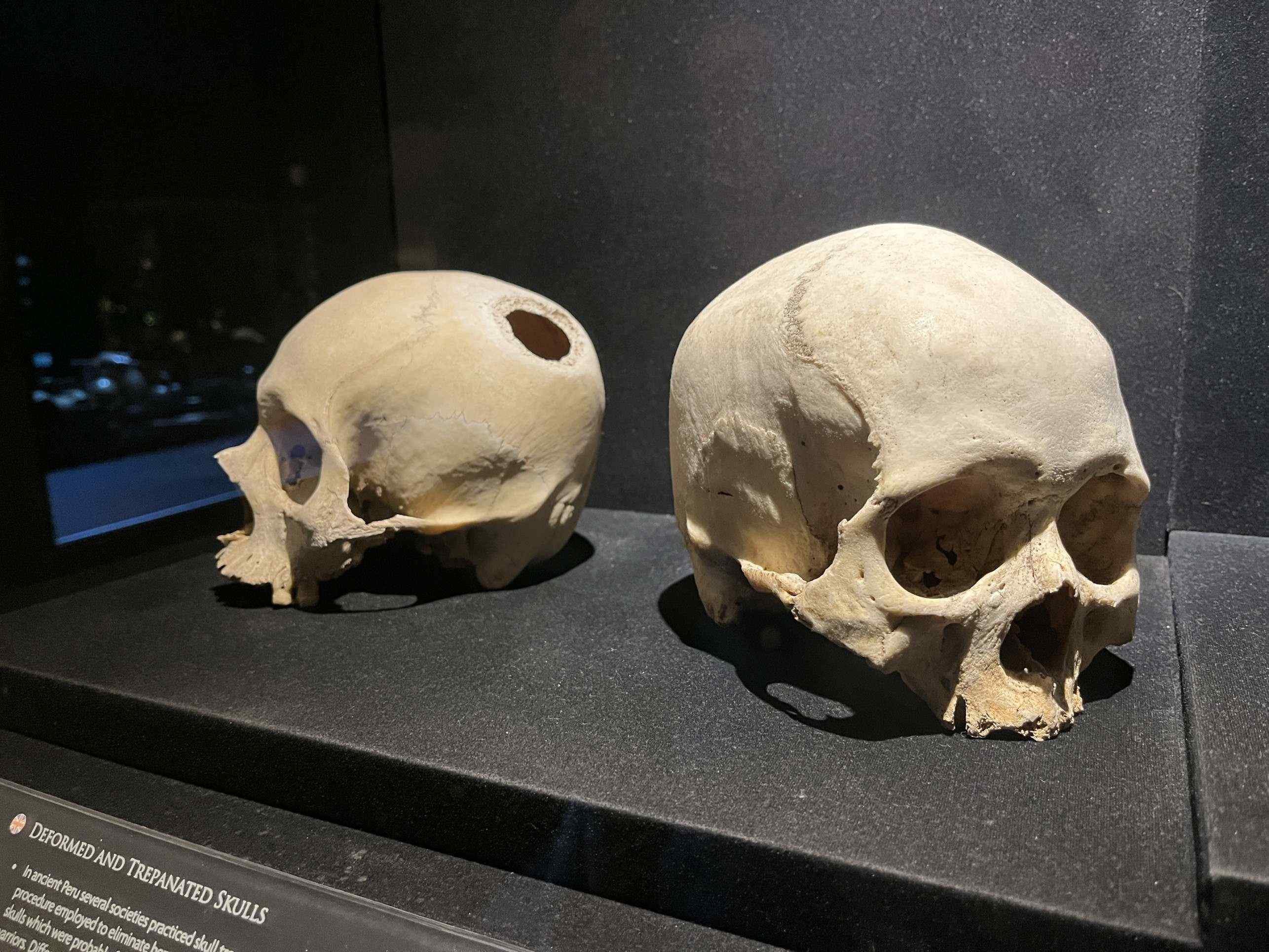 Dois crânios que passararm por trepanação, procedimento milenar que consistia na abertura de uma cavidade circular e era utilizada para tratar hematomas, sangramentos, enxaquecas, problemas de pressão intracraniana e convulsões