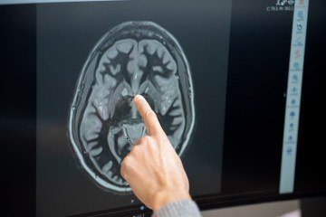 Casey Halpern aponta para o núcleo accumbens em uma tomografia computadorizada do cérebro de um paciente -  (crédito: Penn Medicine)