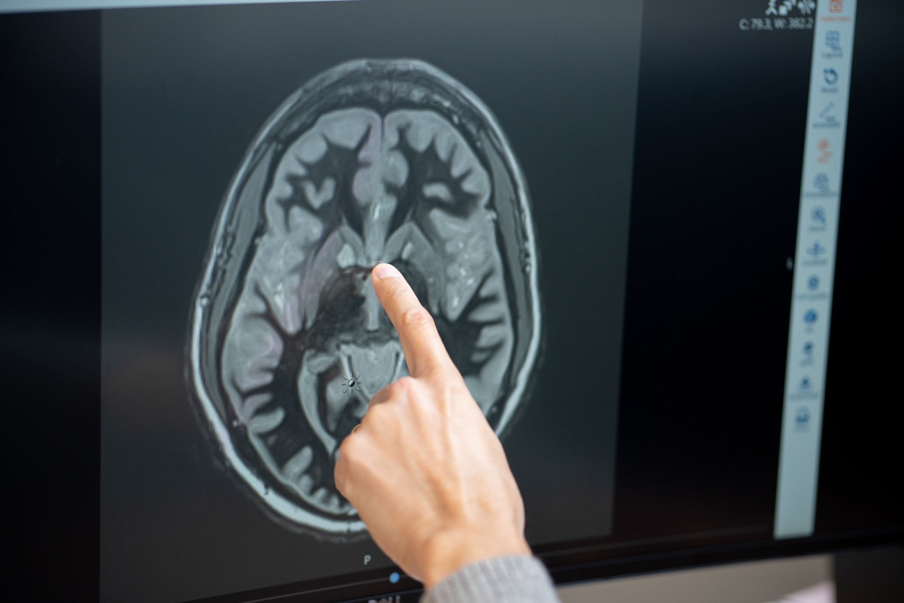 Remédio para diabetes é esperança contra a compulsão alimentar