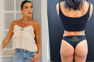 Camila Dias realiza harmonização glútea com ácido hialurônico corporal e alerta sobre segurança em procedimentos estéticos -  (crédito: Divulgação)