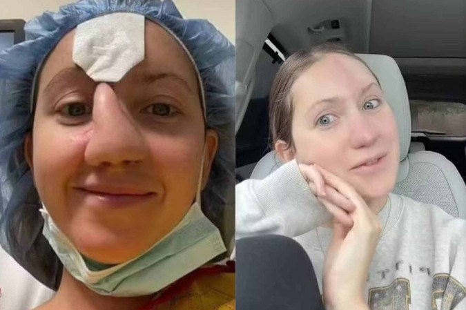 Jordan Wilson, de 29 anos, teve que passar por 16 procedimentos cirúrgicos para reconstruir o rosto e o nariz -  (crédito: Reprodução/@sincerelyjord_)