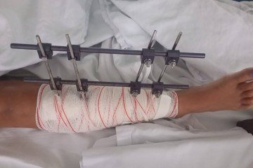 Criança atropelada por motociclista em Valparaíso (GO) fraturou perna -  (crédito: Material cedido ao Correio)