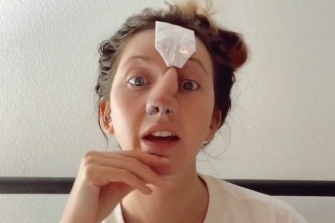 Jordan Wilson, de 29 anos, teve que passar por 16 procedimentos cirúrgicos para reconstruir o rosto e o nariz