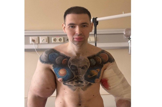 O influenciador Kirill Tereshin, já durante o tratamento, em postagem feita em junho deste ano -  (crédito: Reprodução / Instagram / @ruki_bazuki_official)