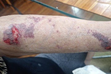 Ferimentos provocados por um assaltante em uma moradora da Asa Norte, na terça-feira -  (crédito: Reprodução/Redes sociais)