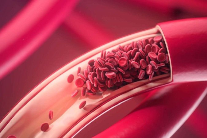 A combinação de calor e imobilidade prolongada eleva o risco de trombose (Imagem: KateStudio | Shutterstock) - (crédito: EdiCase) A combinação de calor e imobilidade prolongada eleva o risco de trombose (Imagem: KateStudio | Shutterstock) - (crédito: EdiCase)