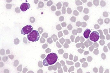 Células linfoblásticas T da leucemia aguda na medula óssea: poucas opções quando o tratamento principal falha - (crédito: WikimediaCommons/Divulgação ) Células linfoblásticas T da leucemia aguda na medula óssea: poucas opções quando o tratamento principal falha - (crédito: WikimediaCommons/Divulgação )
