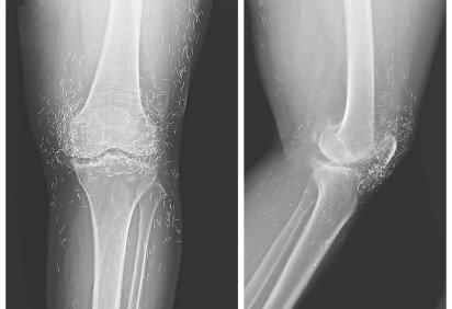Fios de ouro no joelho expõem riscos de terapias sem comprovação -  (crédito: Reprodução/New England Journal of Medicine)