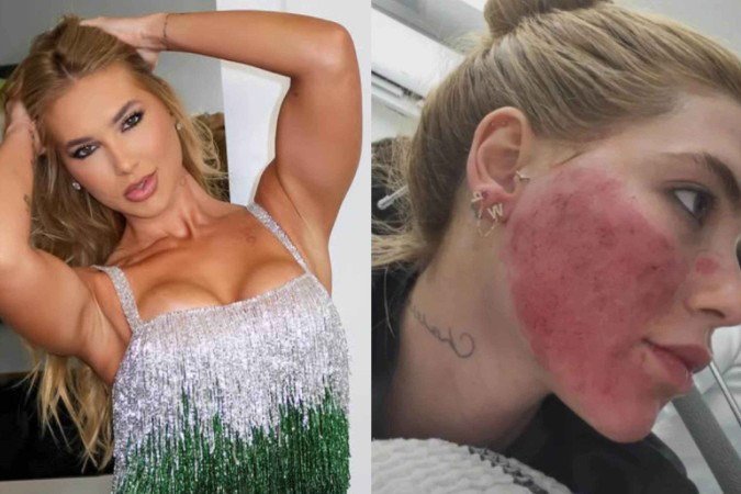 Virginia surge com rosto em carne viva e preocupa público - (crédito: Reprodução/Instagram) Virginia surge com rosto em carne viva e preocupa público - (crédito: Reprodução/Instagram)