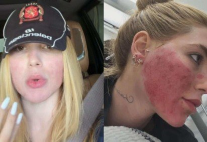 Virginia expõe arrependimento após rosto ficar em carne viva com procedimento -  (crédito: Reprodução/Instagram) -Virginia expõe arrependimento após rosto ficar em carne viva com procedimento -  (crédito: Reprodução/Instagram)