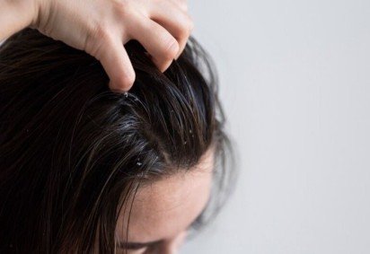 Além disso, provoca uma coceira que provoca incômodo e ecpõe a pessoa a uma situação vexaminosa. Veja algumas dicas simples para evitar a caspa no dia a dia.  -  (crédito: Freepik) -Além disso, provoca uma coceira que provoca incômodo e ecpõe a pessoa a uma situação vexaminosa. Veja algumas dicas simples para evitar a caspa no dia a dia.  -  (crédito: Freepik)