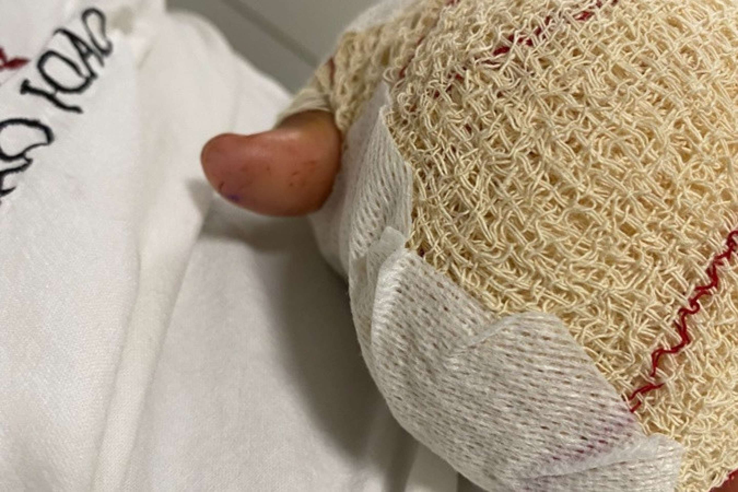 Um mês depois, inquérito sobre estudante que teve dedos decepados está inconcluso