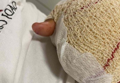 O estudante brasileiro José mal consegue mexer a mão esquerda, que teve dois dedos decepados por alunos de uma escola em Cinfães. O inquérito aberto para investigar a violência continua sem resultado  -  (crédito: Arquivo Pessoal)