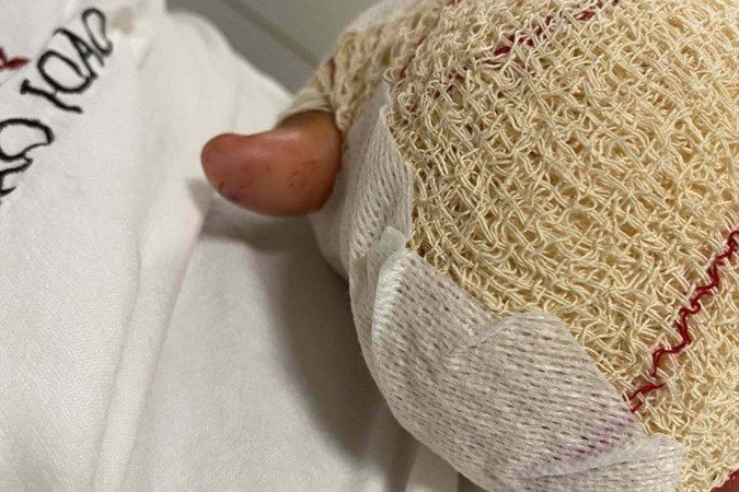 O estudante brasileiro José mal consegue mexer a mão esquerda, que teve dois dedos decepados por alunos de uma escola em Cinfães. O inquérito aberto para investigar a violência continua sem resultado  -  (crédito: Arquivo Pessoal)