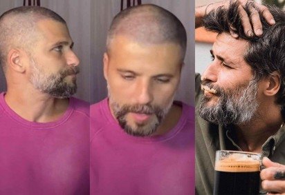 Existe idade certa para transplante capilar? Veja os famosos que fizeram ainda jovens  -  (crédito: Divulgação) -Existe idade certa para transplante capilar? Veja os famosos que fizeram ainda jovens  -  (crédito: Divulgação)