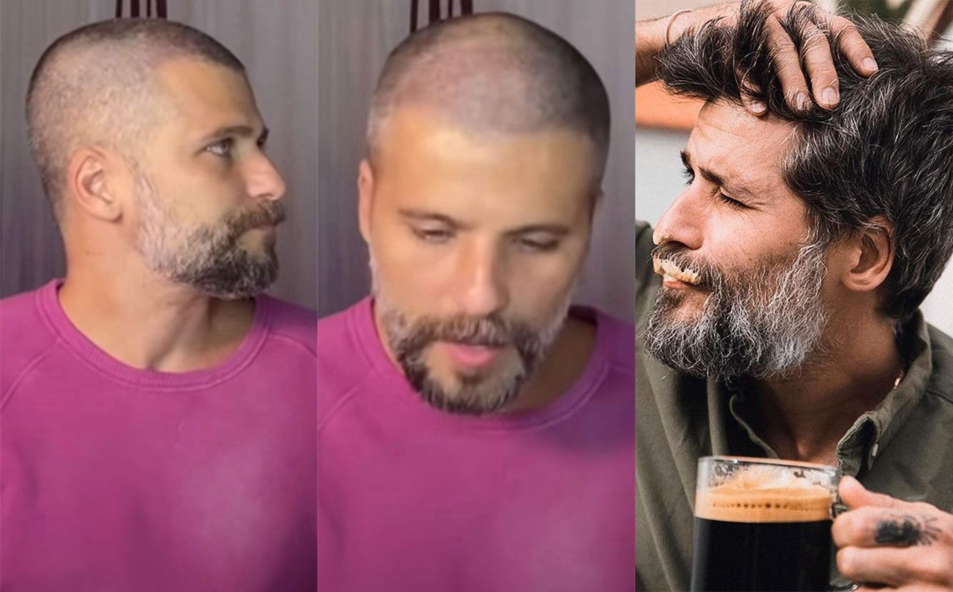 Existe idade certa para transplante capilar? Veja os famosos que fizeram ainda jovens 