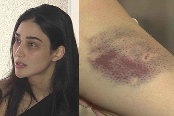 Pollyana teve hematomas por todo o corpo devido às agressões -  (crédito: TV Alterosa)
