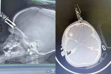 Carregador fica preso no cr&acirc;nio de beb&ecirc;  -  (crédito: Cedido ao Correio)