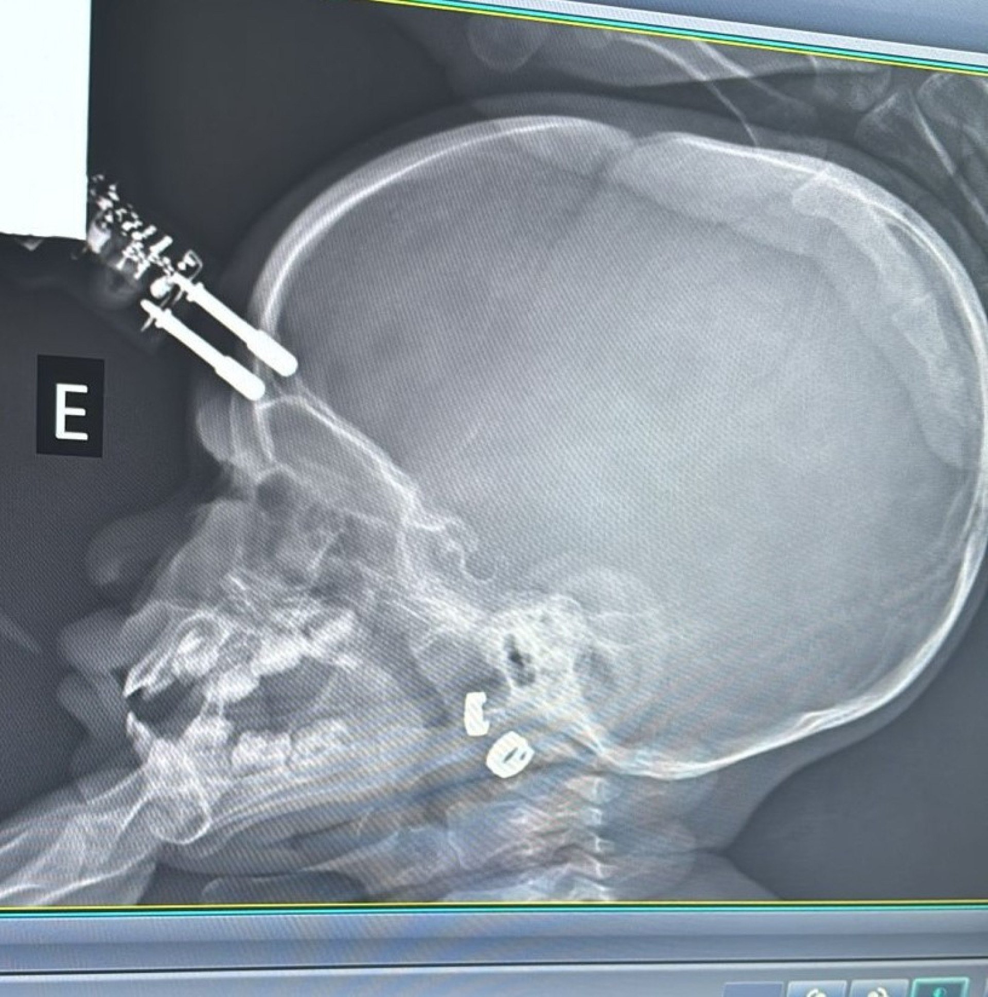 Queda em casa deixa crian&ccedil;a com carregador cravado no cr&acirc;nio