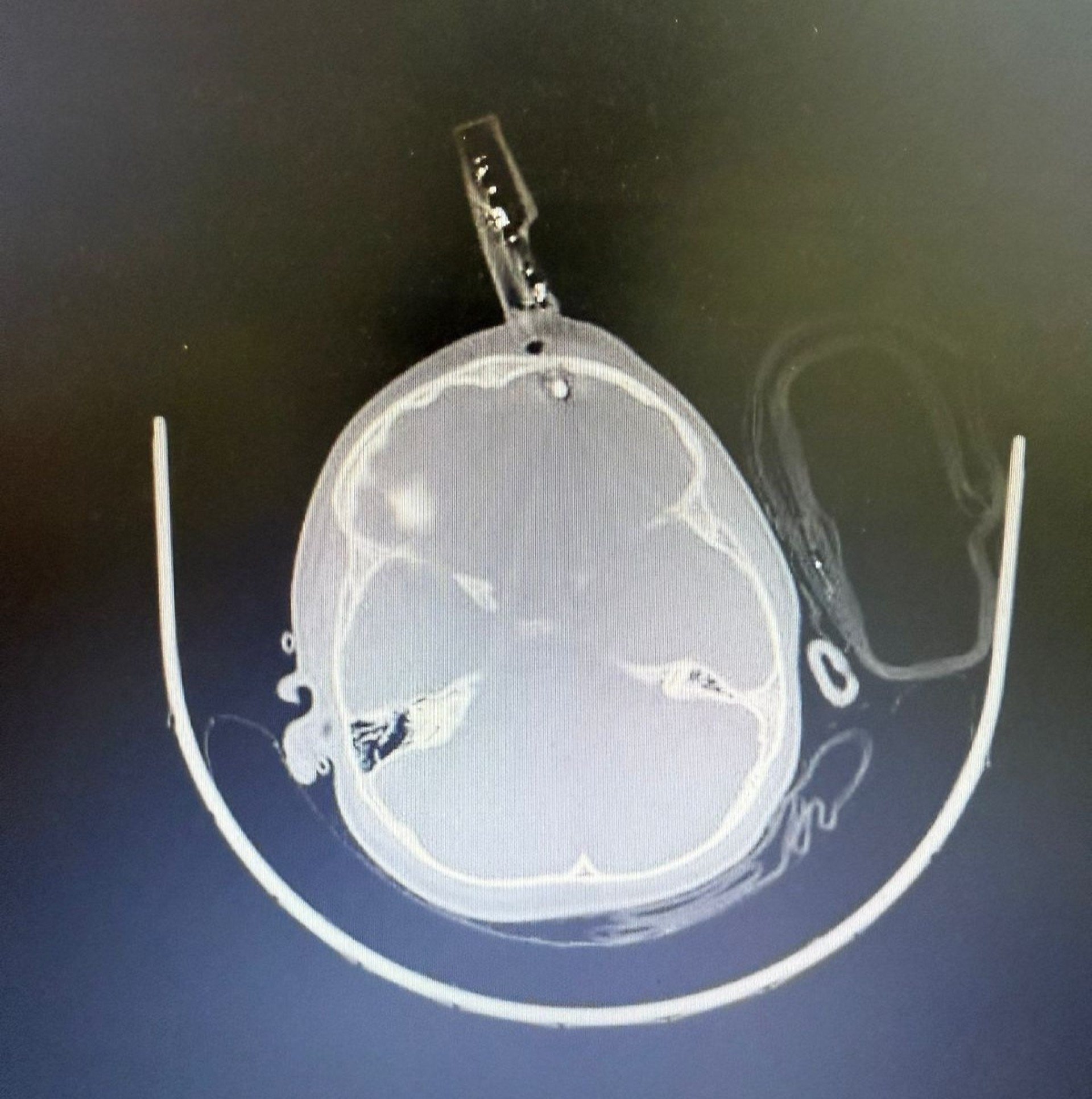 Queda em casa deixa crian&ccedil;a com carregador cravado no cr&acirc;nio