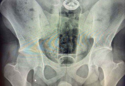 Paciente de 19 anos foi internado ao introduzir um desodorante no ânus e não conseguir retirá-lo  -  (crédito: Reprodução / Redes Sociais ) -Paciente de 19 anos foi internado ao introduzir um desodorante no ânus e não conseguir retirá-lo  -  (crédito: Reprodução / Redes Sociais )