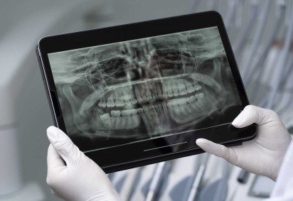 O spray de saliva artificial conseguiu reduzir significativamente a atividade bacteriana e a desmineralização dos dentes, processo no qual perdem cálcio e fosfato, ficando mais suscetíveis às cáries -  (crédito: Reprodução/Freepik) -O spray de saliva artificial conseguiu reduzir significativamente a atividade bacteriana e a desmineralização dos dentes, processo no qual perdem cálcio e fosfato, ficando mais suscetíveis às cáries -  (crédito: Reprodução/Freepik)