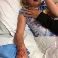 Beleza temporária, dano permanente: os perigos das tatuagens de henna