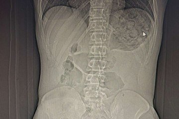 Homem engole drogas, passa por cirurgia e é preso por tráfico em Ceilândia
 -  (crédito: Cedido ao Correio)