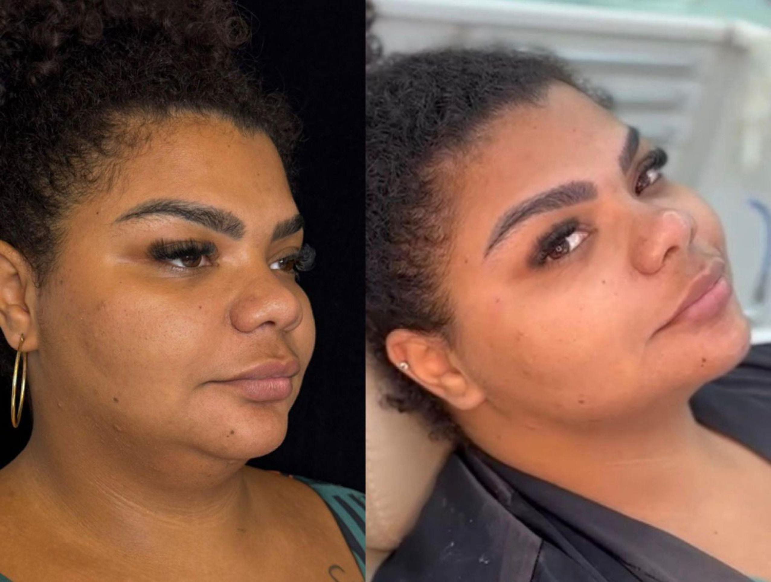 Flora e Babi Cruz apostam em tratamentos estéticos para o Carnaval