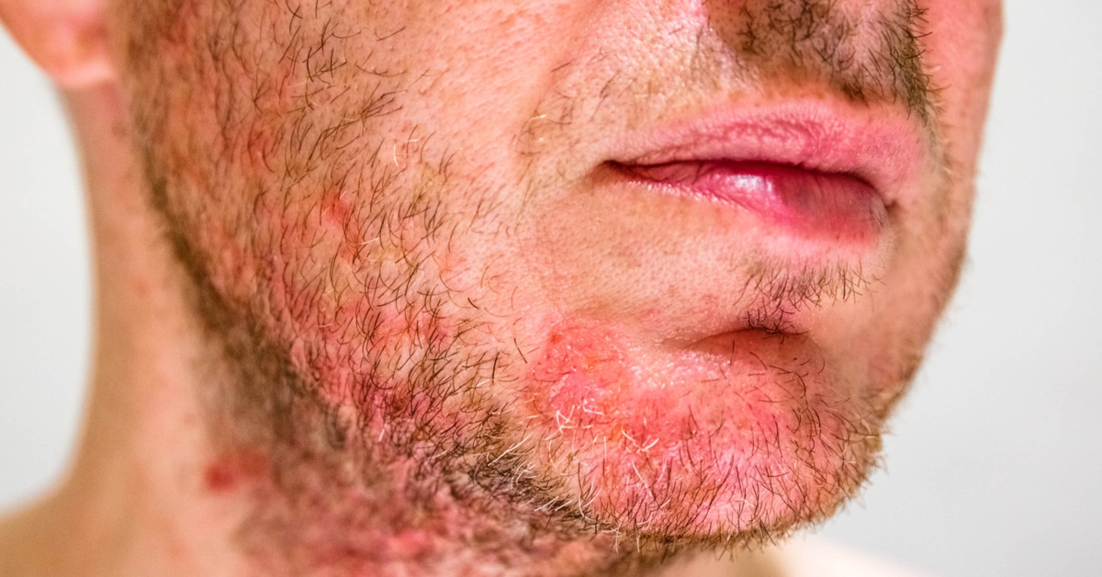 Pequena lesão, grande incômodo: o que é foliculite e como tratar